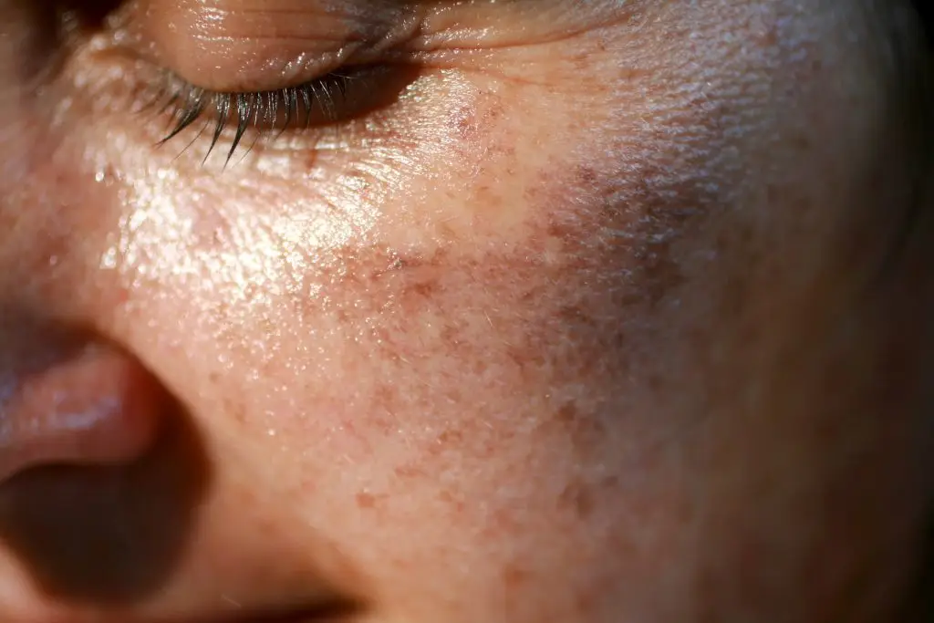 Pigmented spots on the face. Pigmentation on cheeks