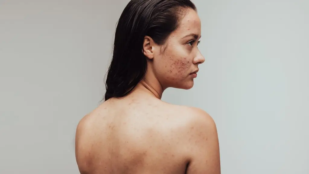 Blemiderm in Leamington Spa at Restore Skin