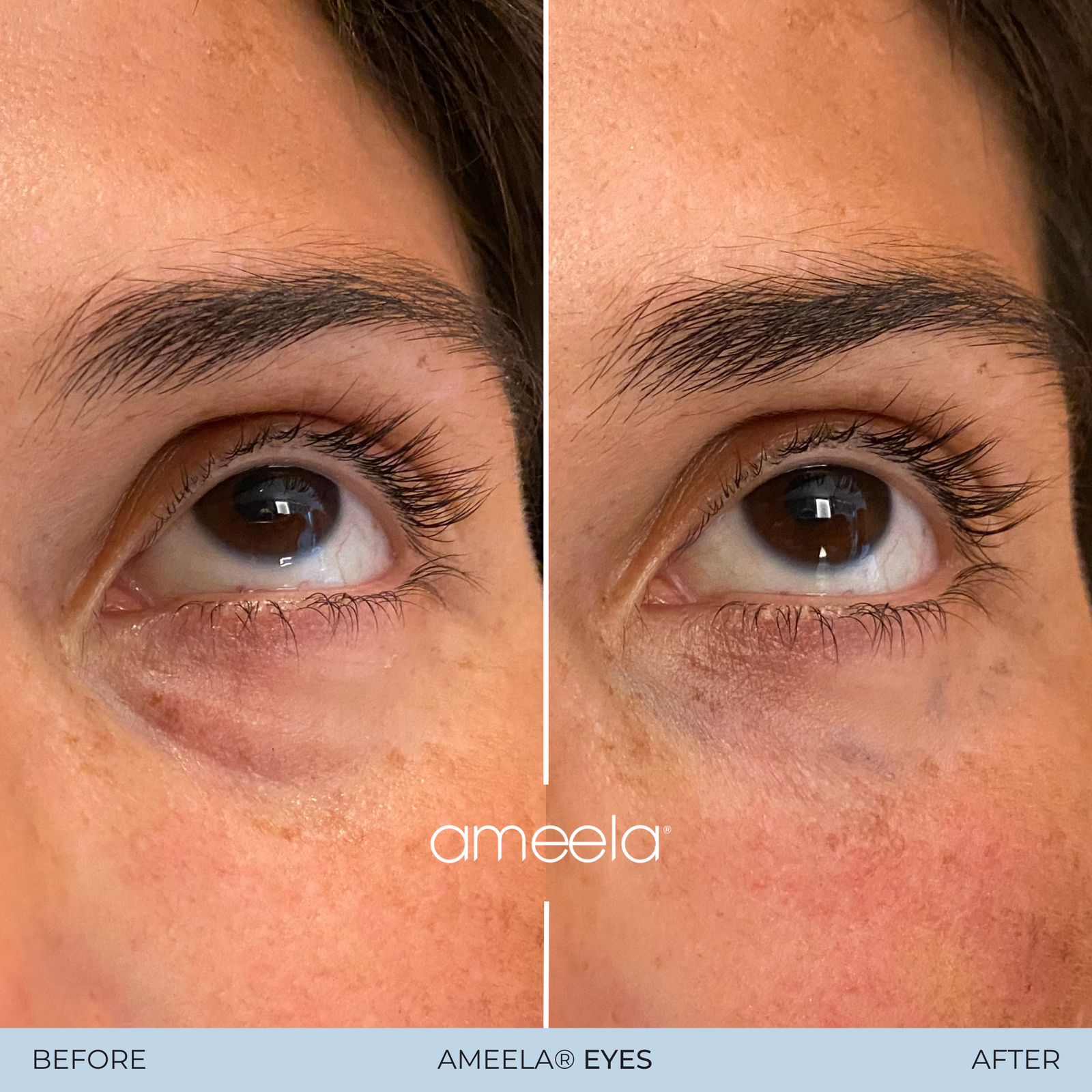 Copy of Copy of Ameela Eyes - Before_After 01