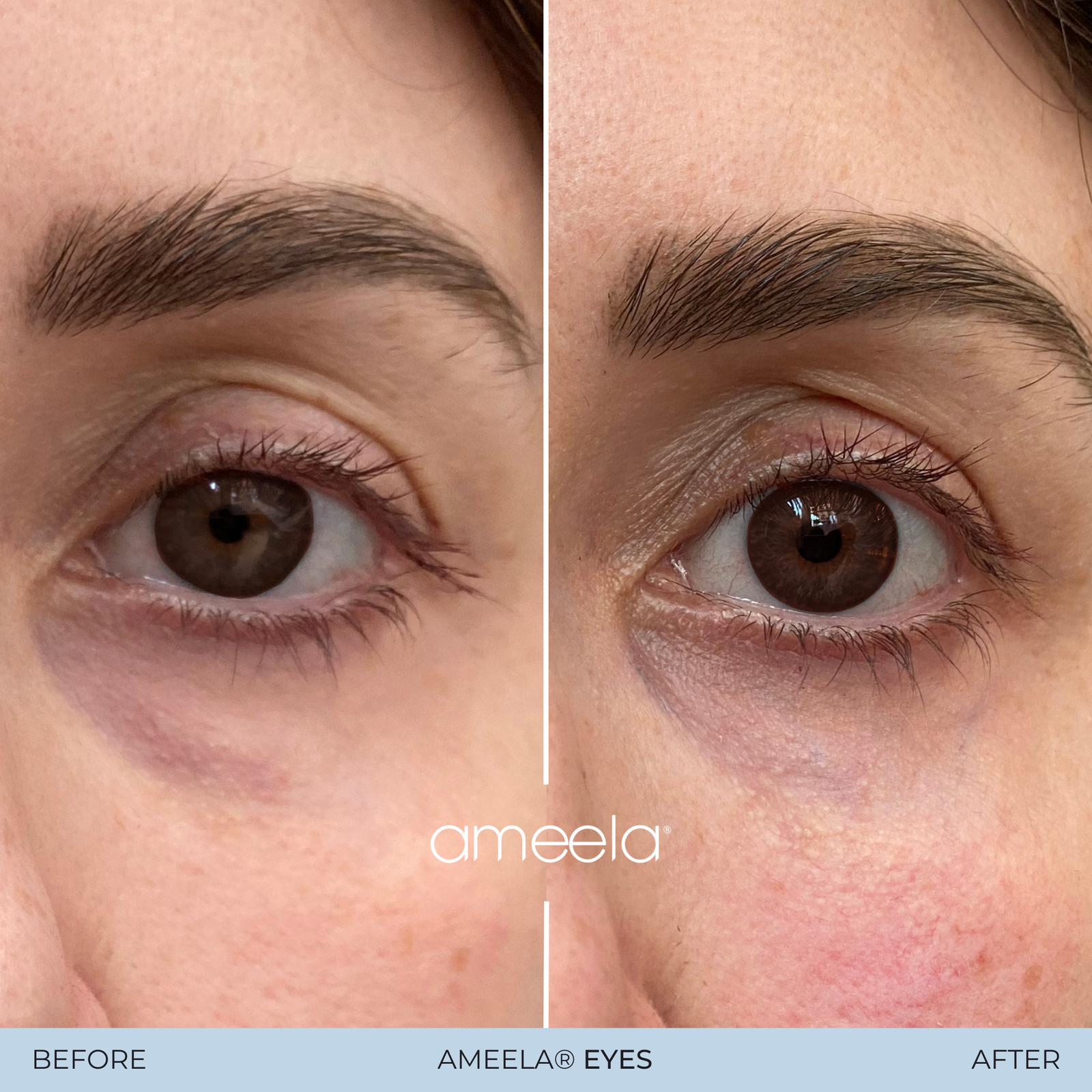 Copy of Copy of Ameela Eyes - Before_After 03