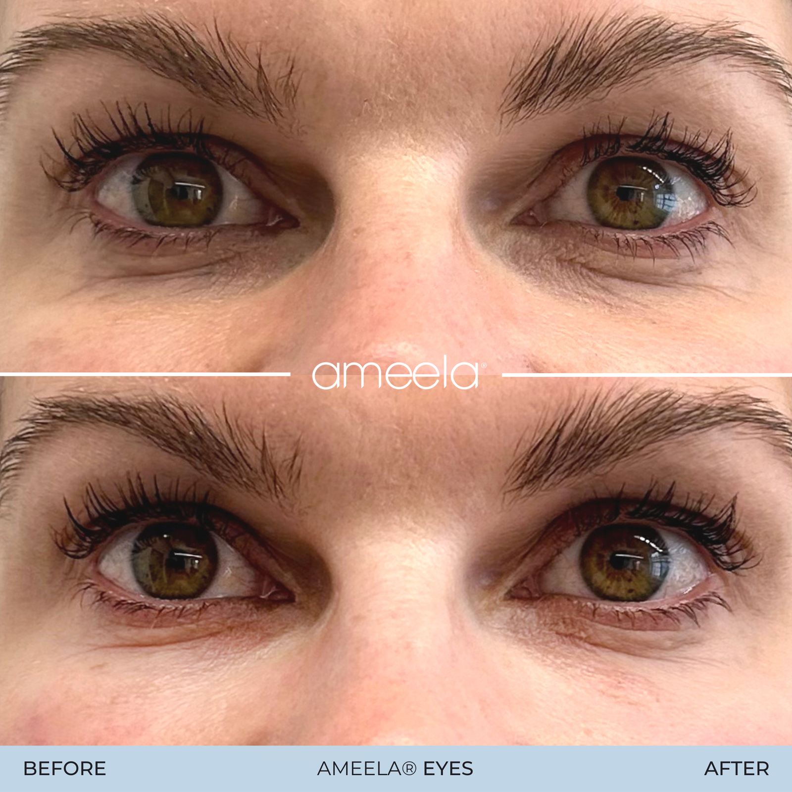 Copy of Copy of Ameela Eyes - Before_After 10