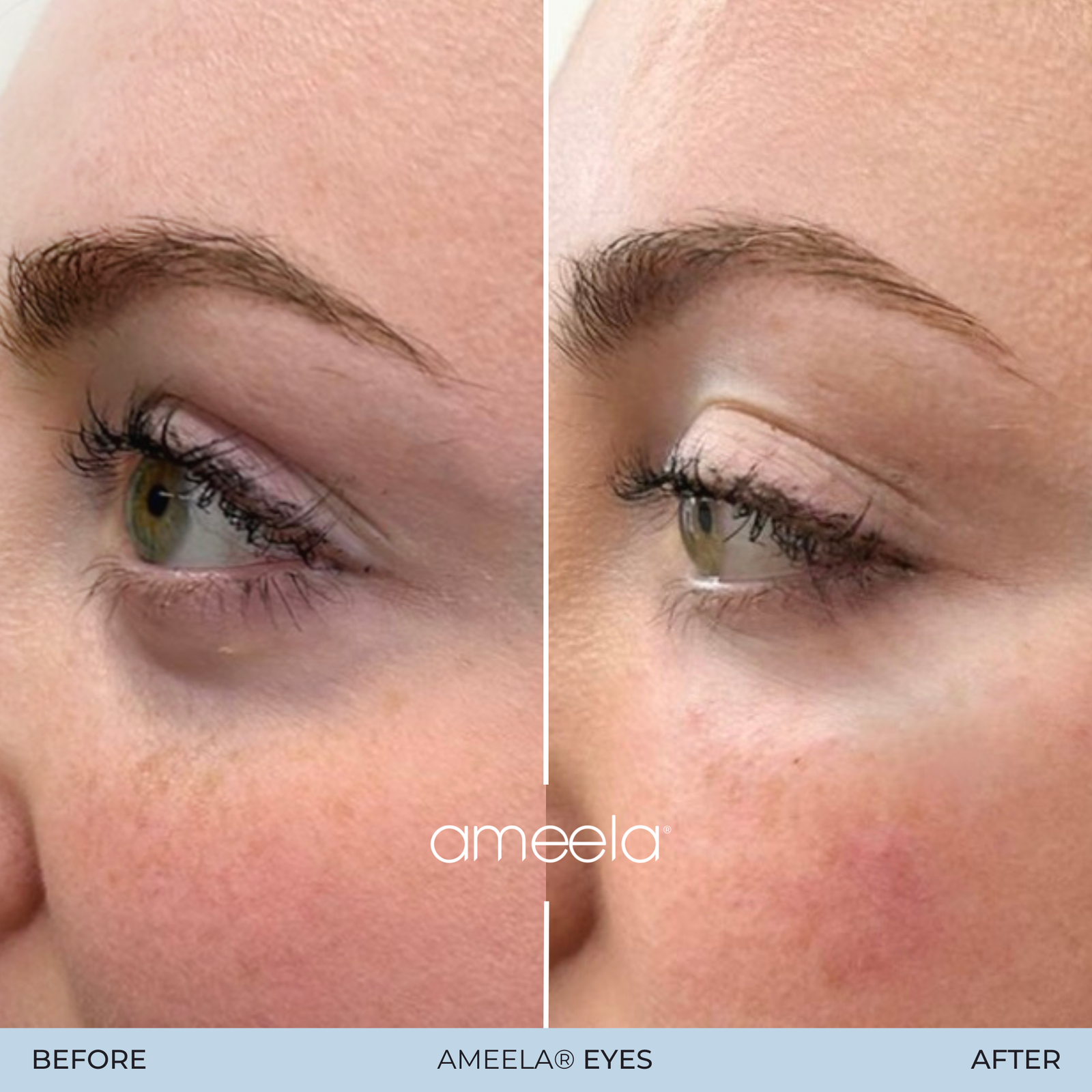 Copy of Copy of Ameela Eyes - Before_After 11